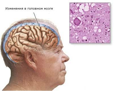 крейцфельда-якоба