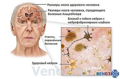 альцгеймера альцгеймера