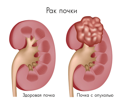 лечение рака