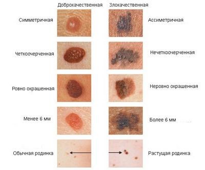 меланомы меланомы