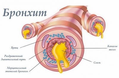 бронхит бронхит