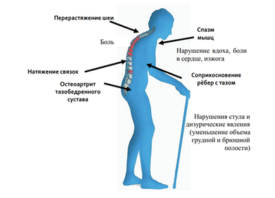 Новая технология визуализации предсказывает риск перелома