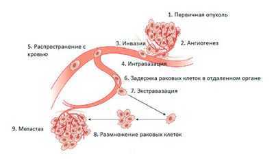 Как распространяется рак: метастатическая опухоль - гибрид раковой клетки и лейкоцита