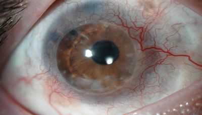 В Ирландии проведена первая трансплантация стволовых клеток роговицы