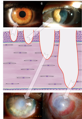 Роль стволовых клеток в обновлении роговицы